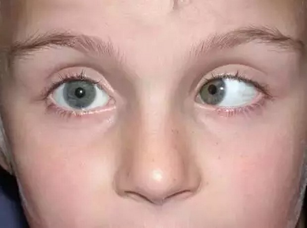 所谓斜视是指注视东西时两只眼睛的方向不一致,这不仅仅是影响宝宝