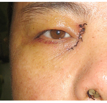 鼻内窥镜泪囊鼻腔吻合术让你告别"林妹妹"